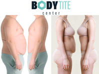 Body Tite: выпирающий и дряблый до - плоский и подтянутый через 2 часа Body Tite: выпирающий и дряблый до - плоский и подтянутый через 2 часа