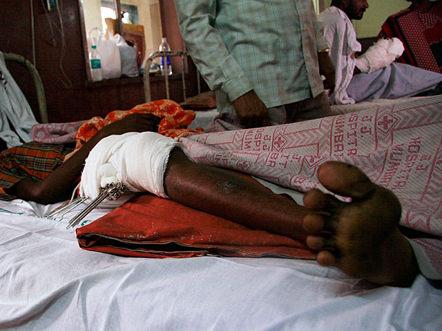Шокирующее видео: подушкой для пациента больницы в Индии служит отрезанная нога  