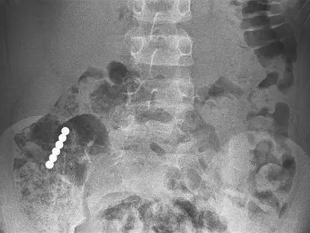 Prompt medical attention saves nine-year-old boy who swallowed multiple magnets