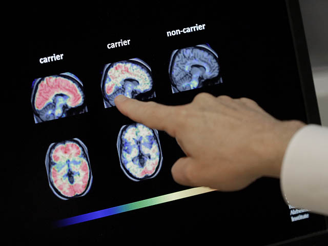 Alzheimer’s Disease Progression Slowing Drug Receives FDA Approval