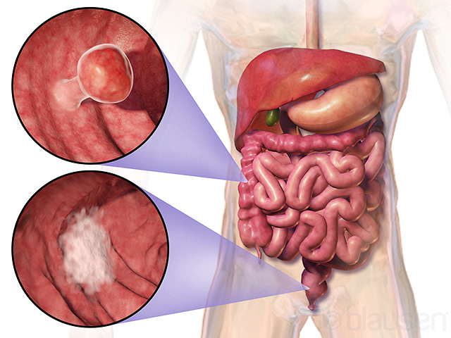 Researchers: Stress may cause bowel cancer in young people