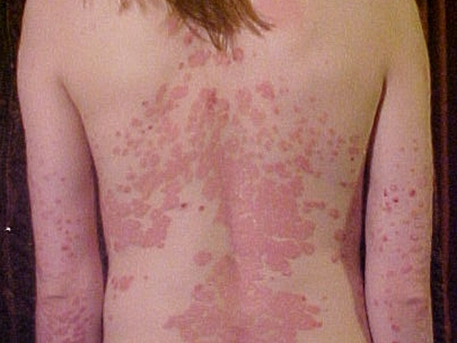 Псориаз у детей связан с разводом и расставанием родителей, показало исследование