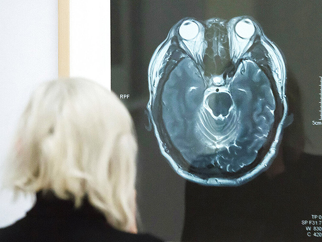 Alzheimer’s disease may be caused by disruption of the sleep-wake cycle