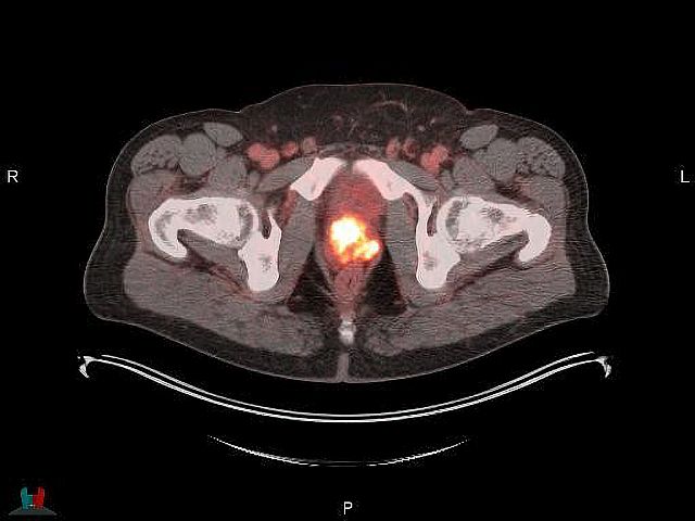 Мужчины предпочитают не говорить о проблемах с простатой
