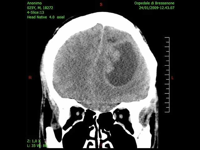 Израильские ученые предложили новый подход к лечению рака мозга