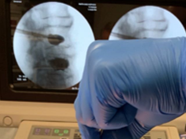 Стволовые клетки из жировой ткани могут восстанавливать переломы позвоночника