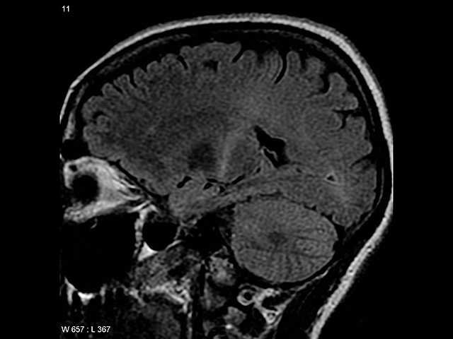 Израильские ученые нашли механизм, запускающий "болезнь Хокинга", и его остановили