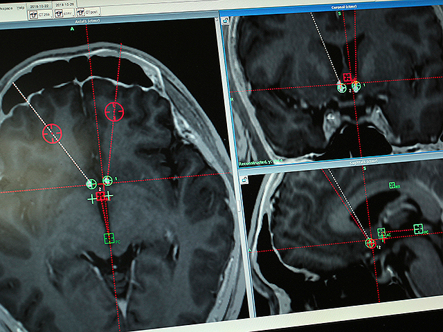 Неизлеченное апноэ во сне повышает риск болезни Паркинсона, показало исследование