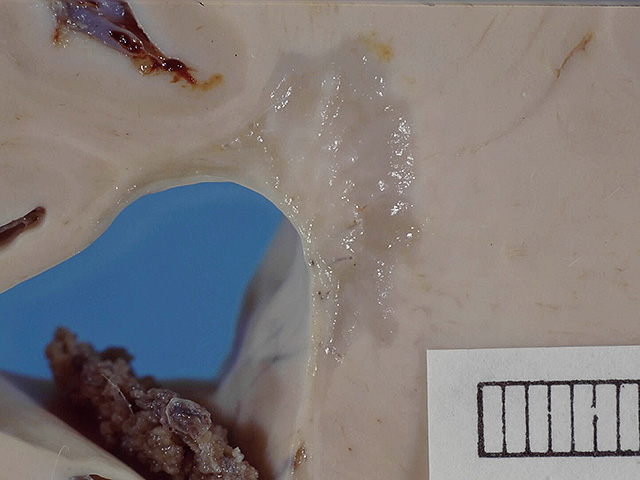 В результате исследования обнаружены два новых подтипа рассеянного склероза