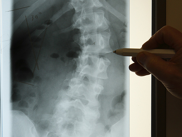 С возрастом иммунные клетки защищают спинной мозг