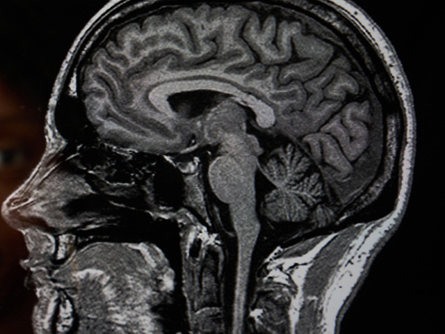 Скончался самый молодой человек с диагнозом деменция