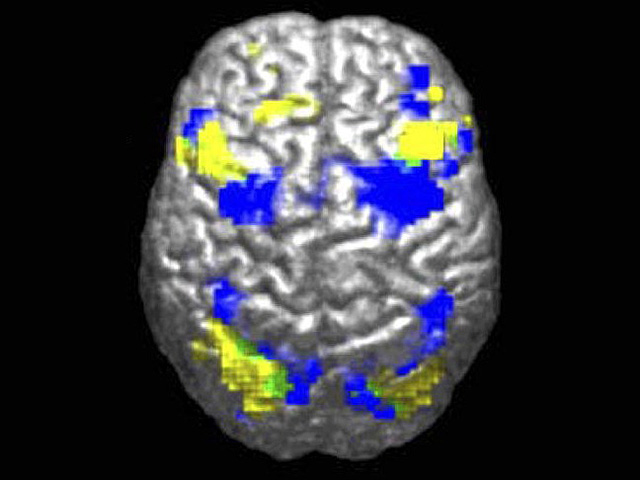Новая модель ИИ может расшифровывать МРТ головного мозга за секунды