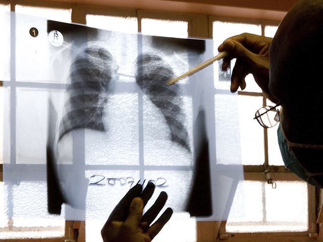 Израильские ученые показали, как рак легких распространяется в мозг, и предложили метод борьбы