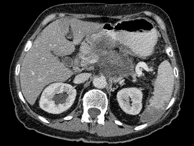 Нервные окончания активно способствуют развитию рака поджелудочной железы