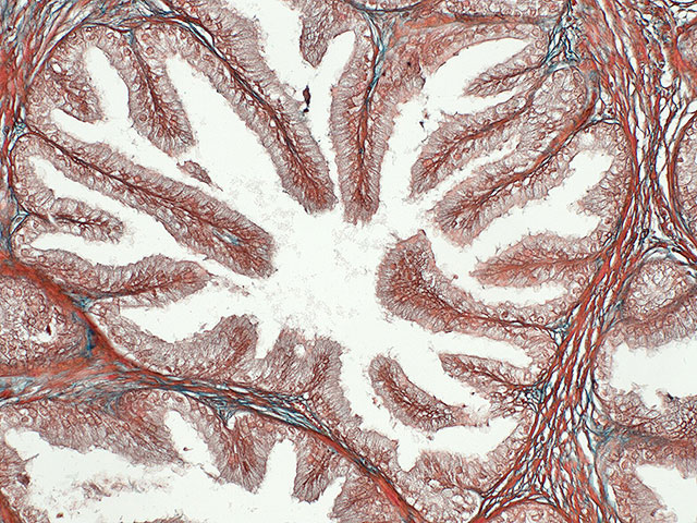 90% опухолей предстательной железы содержат микропластик