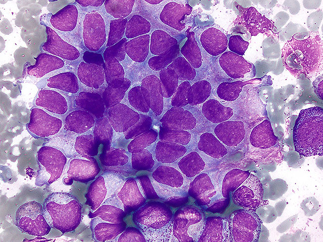 Израильские ученые нашли молекулярный "тормоз" для остановки агрессивной опухоли у детей