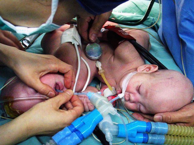 Малазийские врачи разделили 15-месячных сиамских близнецов