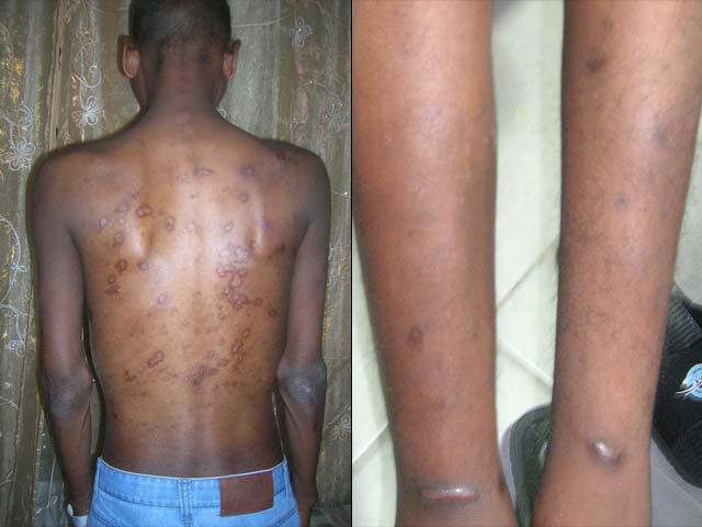 Следы пыток на теле выходца из Эритреи, прошедшего через бедуинский плен на Синае