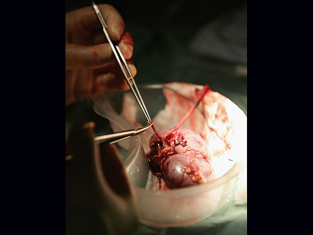     В 2015 году в Израиле был побит рекорд по числу операций по трансплантации почки