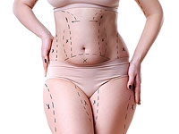 BodyTite: коррекция тела, подтяжка кожи, устранение дряблой шеи, омоложение лица  