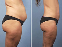 Body Tite: избавление от лишнего жира и подтяжка кожи за 1,5 часа