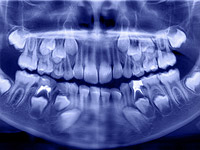 Ученые приблизились к открытию того, как заставить зубы вырасти заново