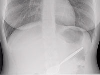     Египетские медики извлекли из желудка пациента 20 ложечек (иллюстрация)