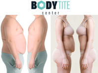 Body Tite: выпирающий и дряблый до - плоский и подтянутый через 2 часа