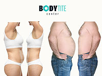 Body Tite : липосакция, подтяжка кожи, устранение двойного подбородка, омоложение лица