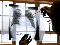 У работницы интерната для людей с особыми потребностями диагностирован туберкулез