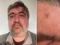 Тележурналист Сергей Гранкин был легко ранен в результате "каменной атаки" в Самарии