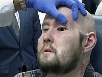 Впервые в истории человеку проведена трансплантация донорского глаза, нервов и части лица