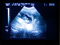 Во Флориде вступил в силу "Закон о защите сердцебиения", ограничивающий аборты