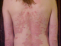 Псориаз у детей связан с разводом и расставанием родителей, показало исследование Псориаз у детей связан с разводом и расставанием родителей, показало исследование