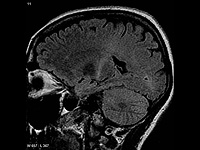 Израильские ученые нашли механизм, запускающий "болезнь Хокинга", и его остановили