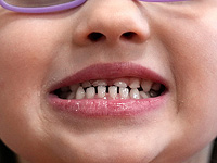 У детей, чьи мамы находятся в состоянии стресса, зубы прорезываются раньше