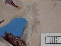 В результате исследования обнаружены два новых подтипа рассеянного склероза