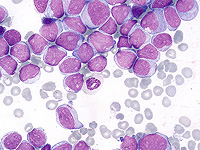 Исследователи обнаружили, что препарат от рака груди повышает эффективность лечения лейкемии