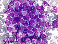 Израильские ученые нашли молекулярный "тормоз" для остановки агрессивной опухоли у детей