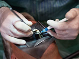 Стоматолог отомстила бывшему мужу, удалив ему все зубы