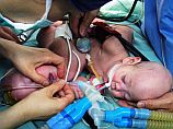 Малазийские врачи разделили 15-месячных сиамских близнецов