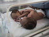 Израильским медикам не удалось спасти новорожденных сиамских близнецов из Хеврона 