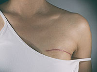 Женщина, которой удалили грудь из-за ошибки в анализе, требует от больницы 800 тысяч шекелей