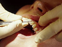 Стоматолог из Санкт-Петербурга вырвала пациентке 22 здоровых зуба