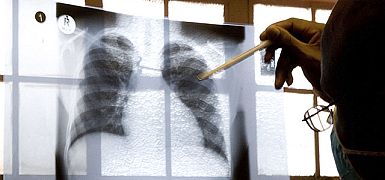 Израильские ученые показали, как рак легких распространяется в мозг, и предложили метод борьбы